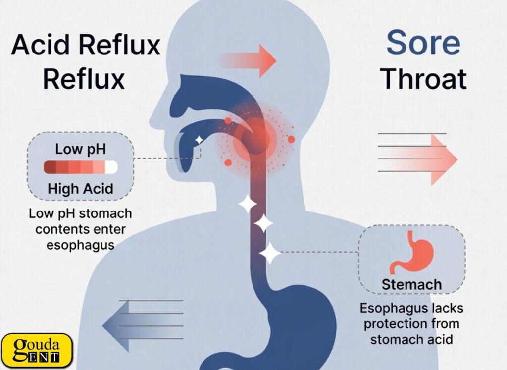 Visual diagram explaining the connection between Sore Throat and Acid Reflux. It shows how low pH stomach contents enter the esophagus, leading to irritation and causing sore throat symptoms